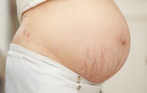 DIY Belly Butters and Creams for Stretch Marks and Skin Health  2