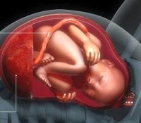 Placenta accreta: ein vollständiger Leitfaden