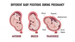 Wie man ein Baby für die Geburt auf natürliche Weise in Position bringt und warum die richtige Position so wichtig ist 1
