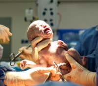 Erhalten Babys, die per Kaiserschnitt zur Welt kommen, weniger wichtige Darmbakterien?