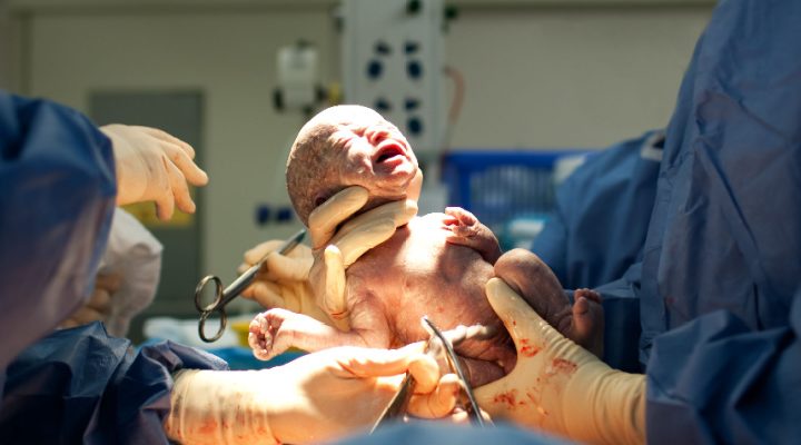 Erhalten Babys, die per Kaiserschnitt zur Welt kommen, weniger wichtige Darmbakterien?