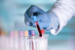 Ein Lipidtest kann das Risiko für Präeklampsie aufzeigen 1