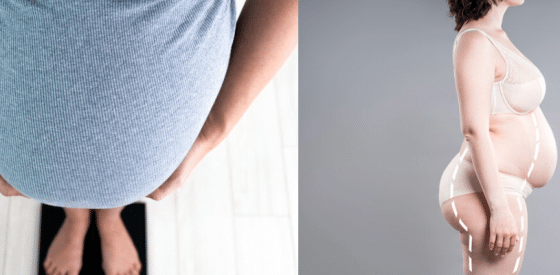 Frauen mit Adipositas müssen während der Schwangerschaft nicht an Gewicht zunehmen, wie eine neue Studie nahelegt