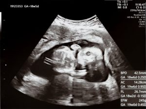 Wissenschaftler finden heraus, dass sich männliche und weibliche Gehirne bereits im Mutterleib unterschiedlich entwickeln 1