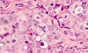 Brustkrebs nach der Geburt: Die ersten Jahre könnten ein besonderes biologisches Risiko darstellen 2